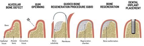 Xerogels para Implantes Óseos de Última Generación: ¿Revolucionando la Regeneración Ósea?